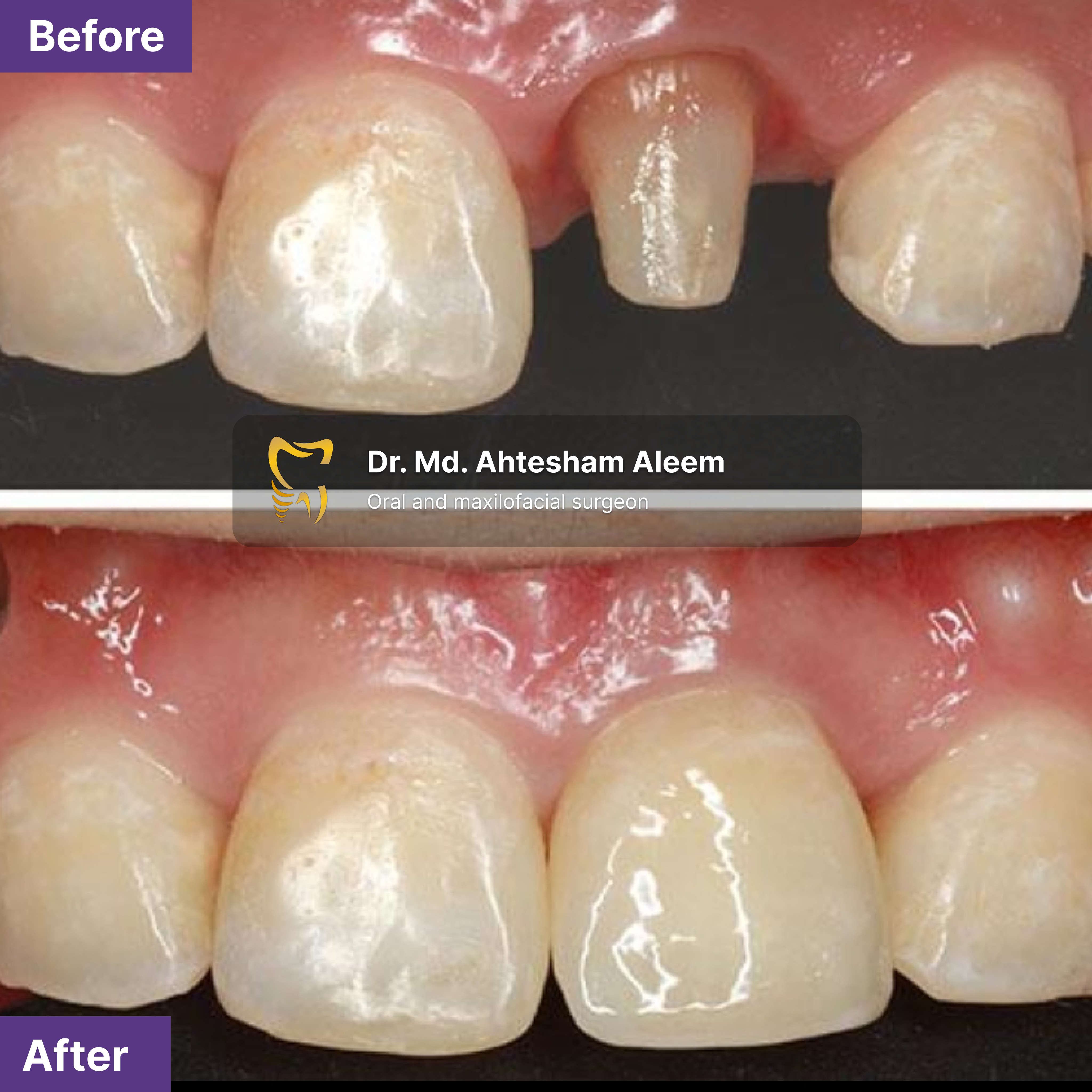 Premium Zirconia Crowns Gallery 1